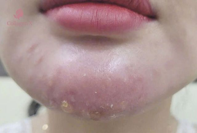 Cách xử lí khi bị bầm