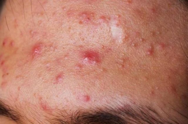 Dị ứng mỹ phẩm là một vấn đề da liễu phổ biến