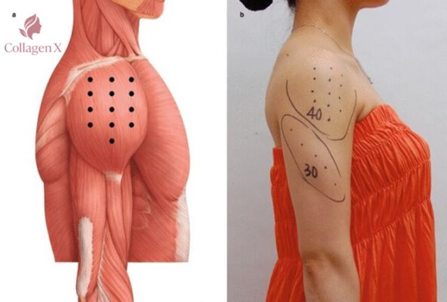 Quy trình tiêm thon gọn bắp tay