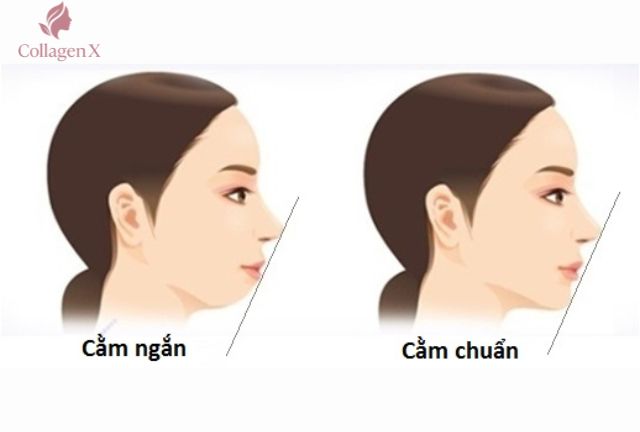 Filler Nào Cho Tiêm Cằm Tròn