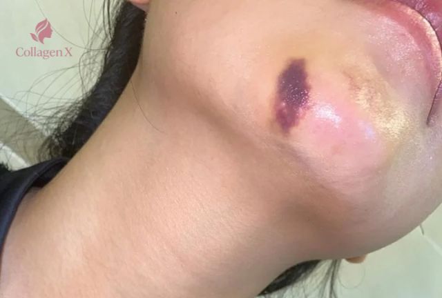Tiêm Filler Bị Bầm
