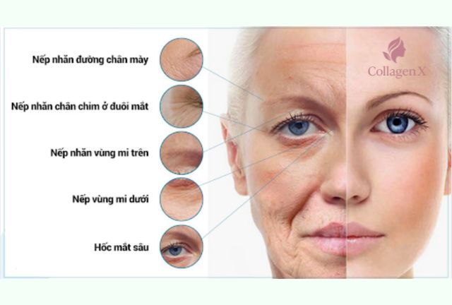 Vị Trí Tiêm Botox Xóa Nhăn
